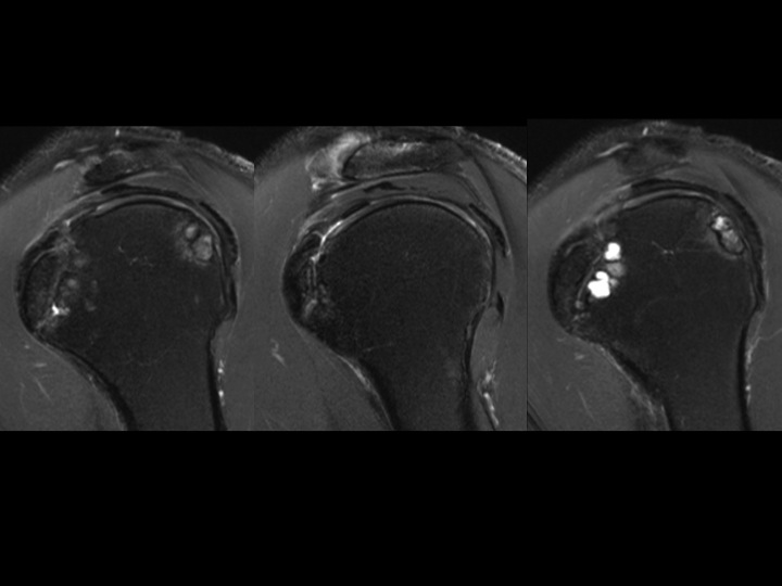 Figure 2 for case Os Subscapularis vs Old Lesser Tuberosity Avulsion